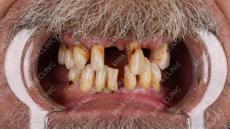 Severe Dental Problems